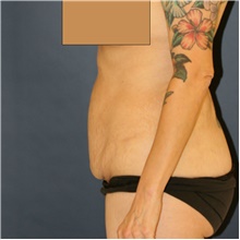 Tummy Tuck Before Photo by Steve Laverson, MD; San Diego, CA - Case 42152