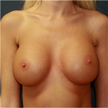 Breast Augmentation After Photo by Steve Laverson, MD, FACS; Rancho Santa Fe, CA - Case 42164