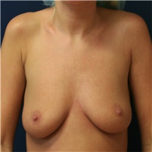 Breast Augmentation Before Photo by Steve Laverson, MD, FACS; San Diego, CA - Case 42164