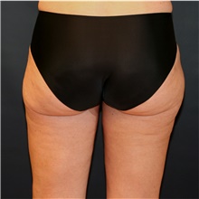 Liposuction After Photo by Steve Laverson, MD, FACS; Rancho Santa Fe, CA - Case 42169