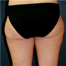 Liposuction Before Photo by Steve Laverson, MD, FACS; Rancho Santa Fe, CA - Case 42169