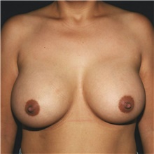 Breast Augmentation After Photo by Steve Laverson, MD, FACS; Rancho Santa Fe, CA - Case 42184
