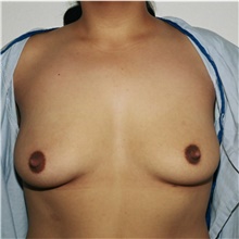 Breast Augmentation Before Photo by Steve Laverson, MD, FACS; San Diego, CA - Case 42184