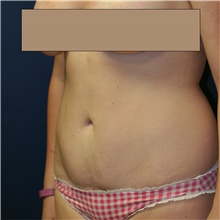 Tummy Tuck After Photo by Steve Laverson, MD, FACS; San Diego, CA - Case 42292
