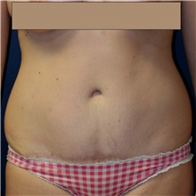 Tummy Tuck After Photo by Steve Laverson, MD, FACS; San Diego, CA - Case 42292