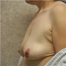 Breast Lift Before Photo by Steve Laverson, MD, FACS; Rancho Santa Fe, CA - Case 42367
