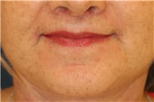 Lip Augmentation/Enhancement After Photo by Steve Laverson, MD, FACS; Rancho Santa Fe, CA - Case 42369