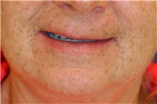 Lip Augmentation/Enhancement Before Photo by Steve Laverson, MD, FACS; San Diego, CA - Case 42369