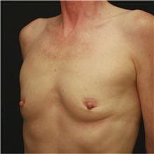 Breast Augmentation Before Photo by Steve Laverson, MD, FACS; Rancho Santa Fe, CA - Case 42449
