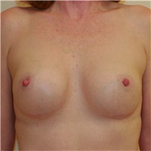 Breast Augmentation After Photo by Steve Laverson, MD, FACS; Rancho Santa Fe, CA - Case 42449