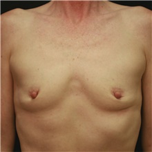 Breast Augmentation Before Photo by Steve Laverson, MD, FACS; Rancho Santa Fe, CA - Case 42449