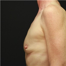 Breast Augmentation Before Photo by Steve Laverson, MD, FACS; Rancho Santa Fe, CA - Case 42449