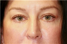 Eyelid Surgery After Photo by Steve Laverson, MD, FACS; San Diego, CA - Case 42450