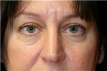 Eyelid Surgery Before Photo by Steve Laverson, MD, FACS; San Diego, CA - Case 42450