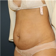 Tummy Tuck Before Photo by Steve Laverson, MD, FACS; San Diego, CA - Case 42452