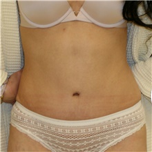 Tummy Tuck After Photo by Steve Laverson, MD, FACS; San Diego, CA - Case 42452