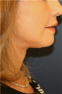 Neck Lift After Photo by Steve Laverson, MD, FACS; Rancho Santa Fe, CA - Case 42453