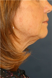 Neck Lift Before Photo by Steve Laverson, MD, FACS; Rancho Santa Fe, CA - Case 42453