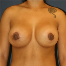 Breast Lift After Photo by Steve Laverson, MD, FACS; Rancho Santa Fe, CA - Case 42461