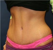 Tummy Tuck After Photo by Steve Laverson, MD, FACS; Rancho Santa Fe, CA - Case 42527