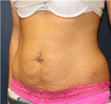 Tummy Tuck Before Photo by Steve Laverson, MD, FACS; Rancho Santa Fe, CA - Case 42527