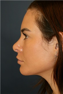 Rhinoplasty After Photo by Steve Laverson, MD, FACS; Rancho Santa Fe, CA - Case 42562