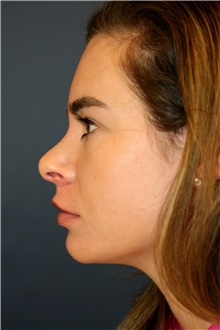 Rhinoplasty Before Photo by Steve Laverson, MD, FACS; Rancho Santa Fe, CA - Case 42562