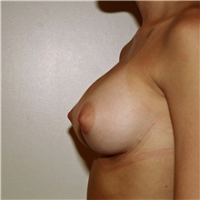 Breast Augmentation After Photo by Steve Laverson, MD, FACS; Rancho Santa Fe, CA - Case 42582