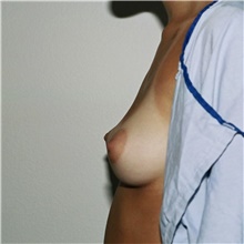Breast Augmentation Before Photo by Steve Laverson, MD, FACS; Rancho Santa Fe, CA - Case 42582