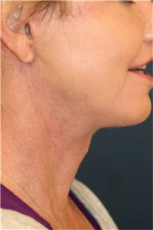 Neck Lift After Photo by Steve Laverson, MD, FACS; Rancho Santa Fe, CA - Case 42591