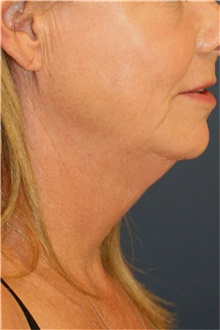 Neck Lift Before Photo by Steve Laverson, MD, FACS; Rancho Santa Fe, CA - Case 42591