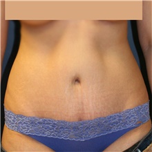 Tummy Tuck After Photo by Steve Laverson, MD, FACS; Rancho Santa Fe, CA - Case 42604