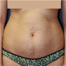 Tummy Tuck Before Photo by Steve Laverson, MD, FACS; San Diego, CA - Case 42604