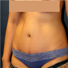 Tummy Tuck After Photo by Steve Laverson, MD, FACS; San Diego, CA - Case 42604