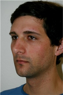 Rhinoplasty Before Photo by Steve Laverson, MD, FACS; Rancho Santa Fe, CA - Case 42615