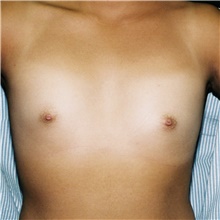 Breast Augmentation Before Photo by Steve Laverson, MD, FACS; San Diego, CA - Case 42630