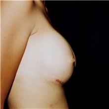 Breast Augmentation After Photo by Steve Laverson, MD, FACS; Rancho Santa Fe, CA - Case 42630