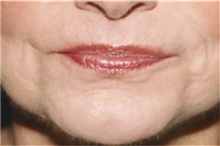 Lip Augmentation/Enhancement After Photo by Steve Laverson, MD, FACS; Rancho Santa Fe, CA - Case 42631