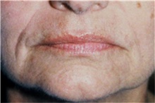 Lip Augmentation/Enhancement Before Photo by Steve Laverson, MD, FACS; Rancho Santa Fe, CA - Case 42631