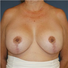 Breast Lift After Photo by Steve Laverson, MD, FACS; Rancho Santa Fe, CA - Case 42651