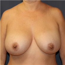 Breast Lift Before Photo by Steve Laverson, MD, FACS; Rancho Santa Fe, CA - Case 42651