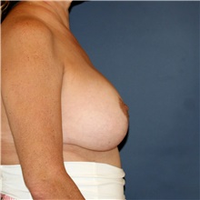 Breast Lift After Photo by Steve Laverson, MD, FACS; Rancho Santa Fe, CA - Case 42651