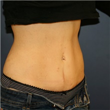 Tummy Tuck After Photo by Steve Laverson, MD, FACS; San Diego, CA - Case 42656