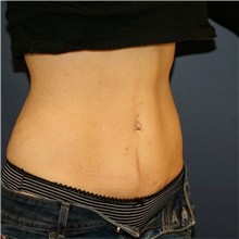 Tummy Tuck After Photo by Steve Laverson, MD, FACS; Rancho Santa Fe, CA - Case 42656