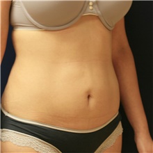 Tummy Tuck Before Photo by Steve Laverson, MD, FACS; Rancho Santa Fe, CA - Case 42656