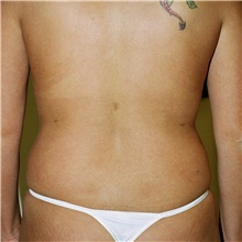 Liposuction After Photo by Steve Laverson, MD, FACS; Rancho Santa Fe, CA - Case 42660