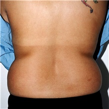 Liposuction Before Photo by Steve Laverson, MD, FACS; Rancho Santa Fe, CA - Case 42660