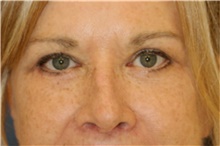 Eyelid Surgery After Photo by Steve Laverson, MD, FACS; Rancho Santa Fe, CA - Case 42661