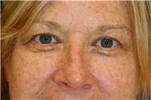 Eyelid Surgery Before Photo by Steve Laverson, MD, FACS; Rancho Santa Fe, CA - Case 42661