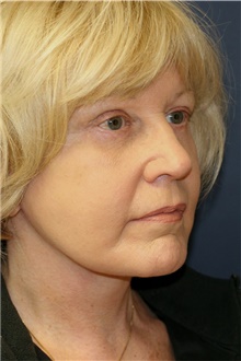 Facelift After Photo by Steve Laverson, MD, FACS; Rancho Santa Fe, CA - Case 42665